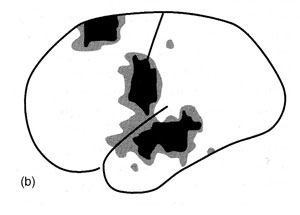 Вернике, Брока