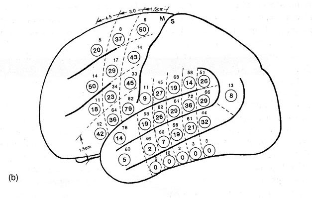 Электрокартографирование перисильвиевых зон мозга